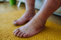 Protecting Your Feet With Regular Diabetic Checkups